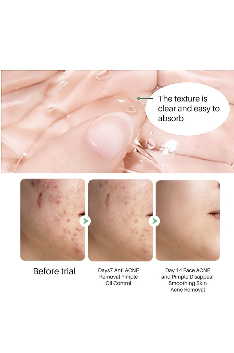 Acne Traces Cream Acne Scars Repair Cream Adolescent Acne Cream - Image 3