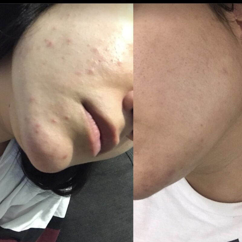 Acne Traces Cream Acne Scars Repair Cream Adolescent Acne Cream - Image 5